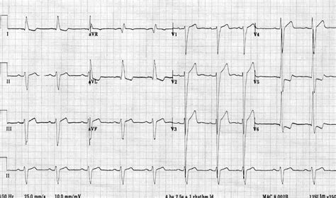 lv hypertrophy ecg